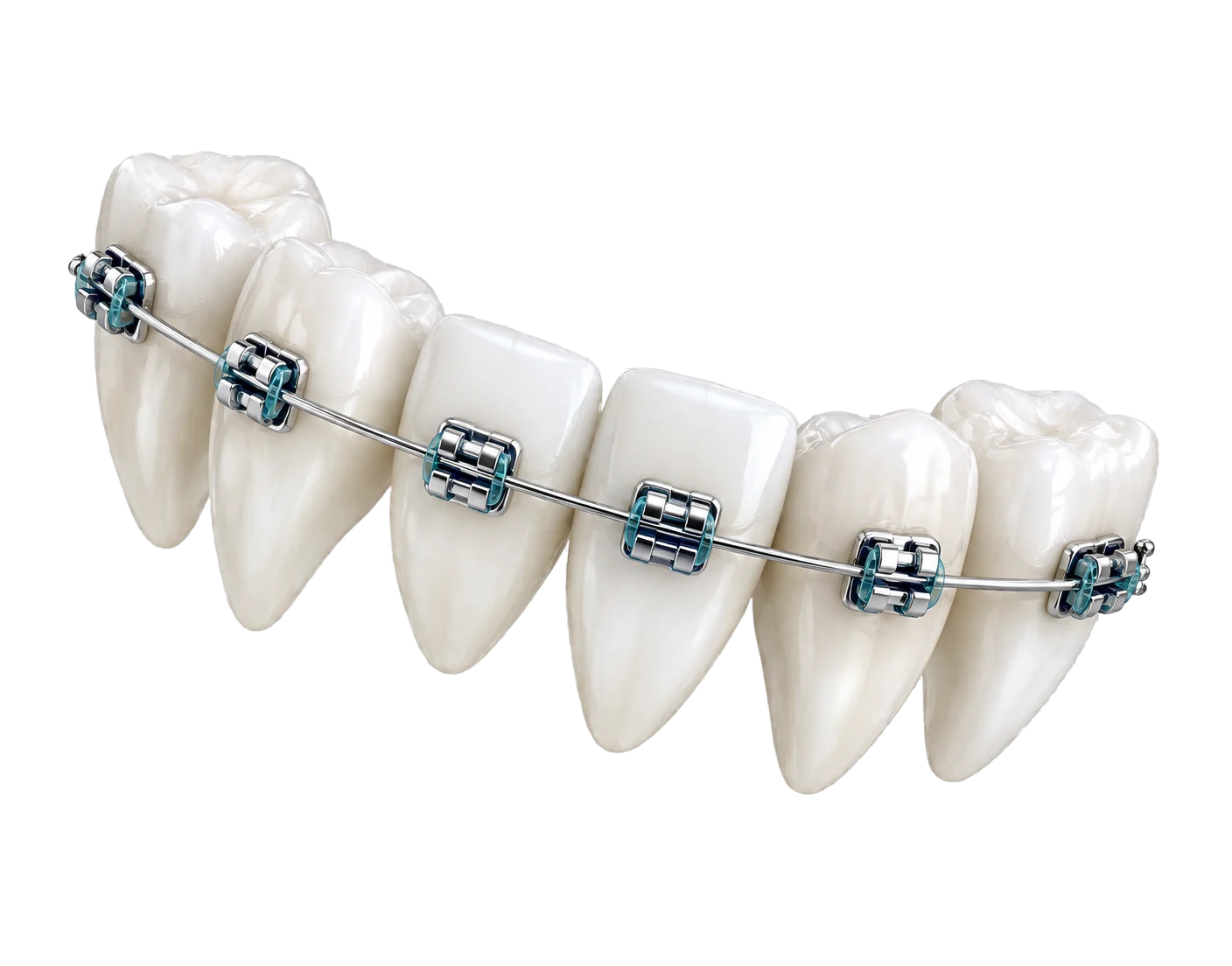 Rangée de dents en céramique avec bagues et arc orthodontiques